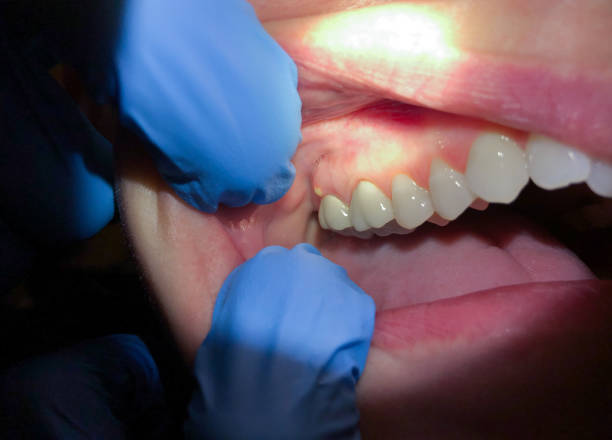 Best Broken or Chipped Tooth Repair in Bladensburg, MD